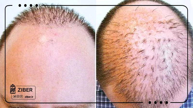 کاشت مو طبیعی به روش BHT